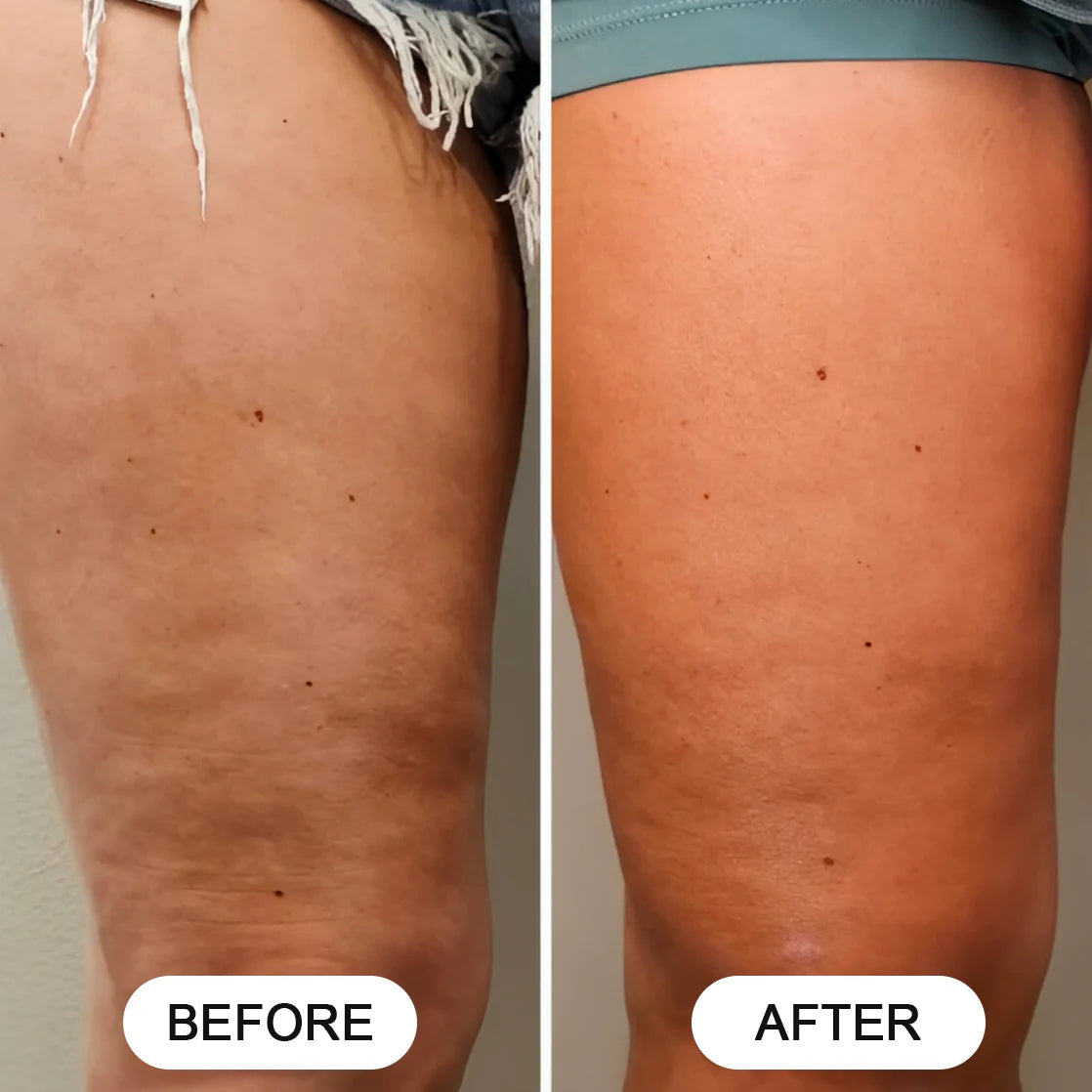 Silea Pro™ Anti-Cellulite Massager