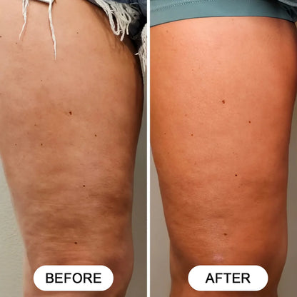 Silea Pro™ Anti-Cellulite Massager